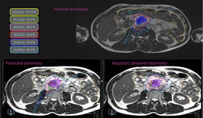 Stereotactic MR-Guided Radiotherapy for Pancreatic Tumors: Dosimetric Benefit of Adaptation and First Clinical Results in a Prospective Registry Study